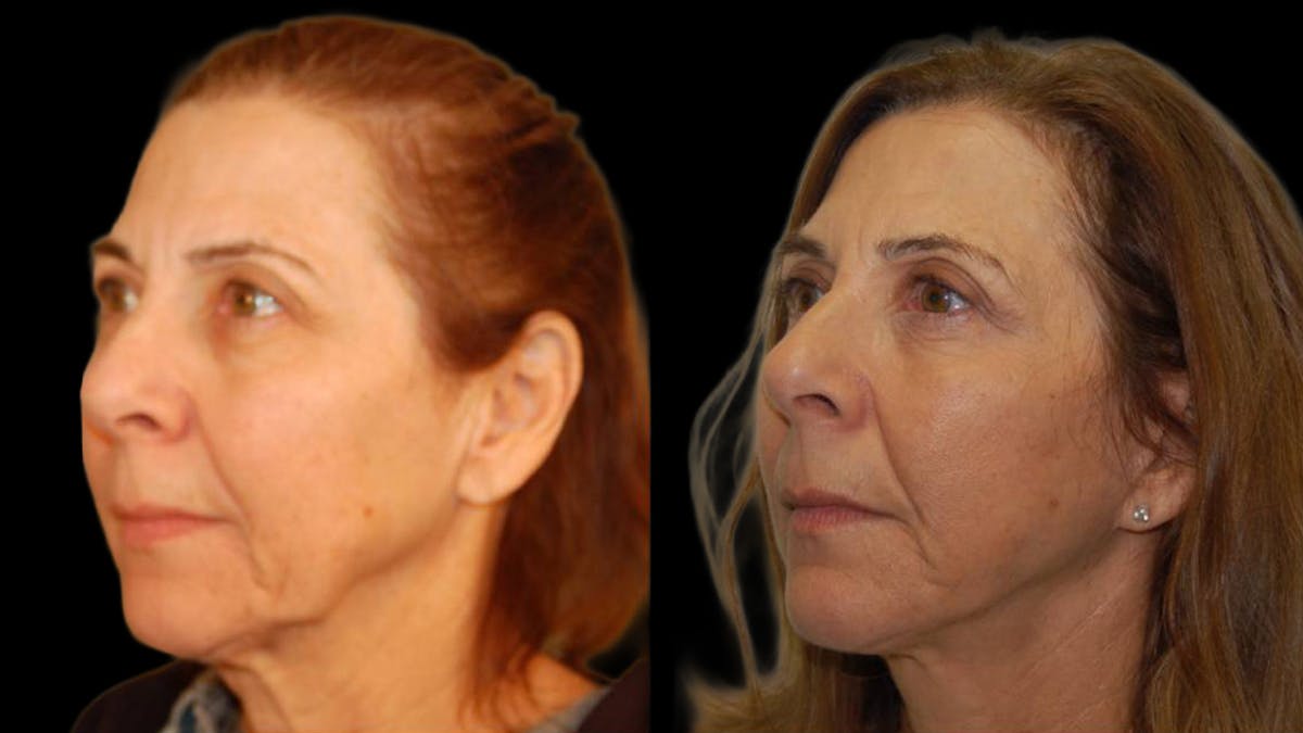 Mini Facelift Before & After Gallery - Patient 547755 - Image 2