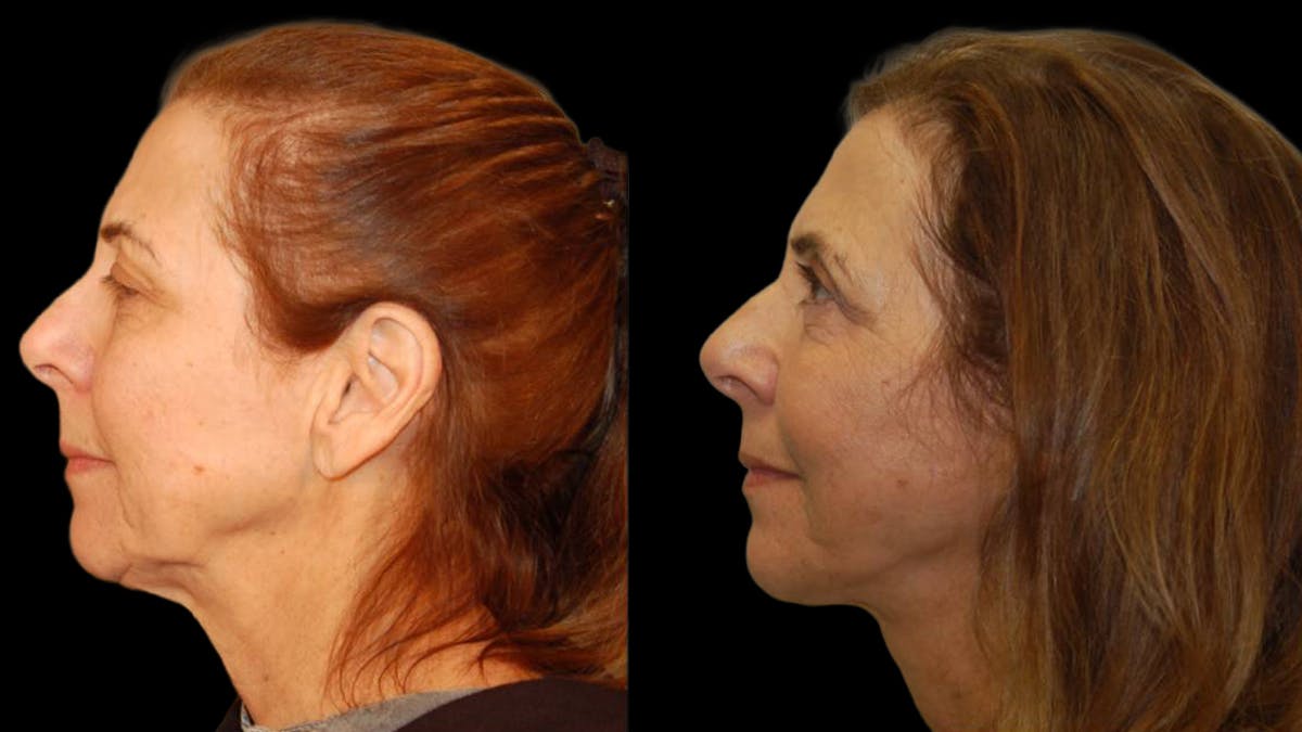 Mini Facelift Before & After Gallery - Patient 547755 - Image 3