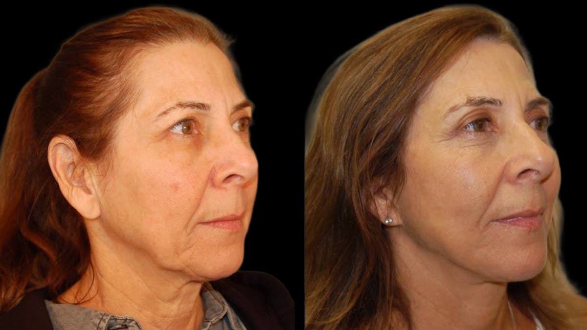 Mini Facelift Before & After Gallery - Patient 547755 - Image 4