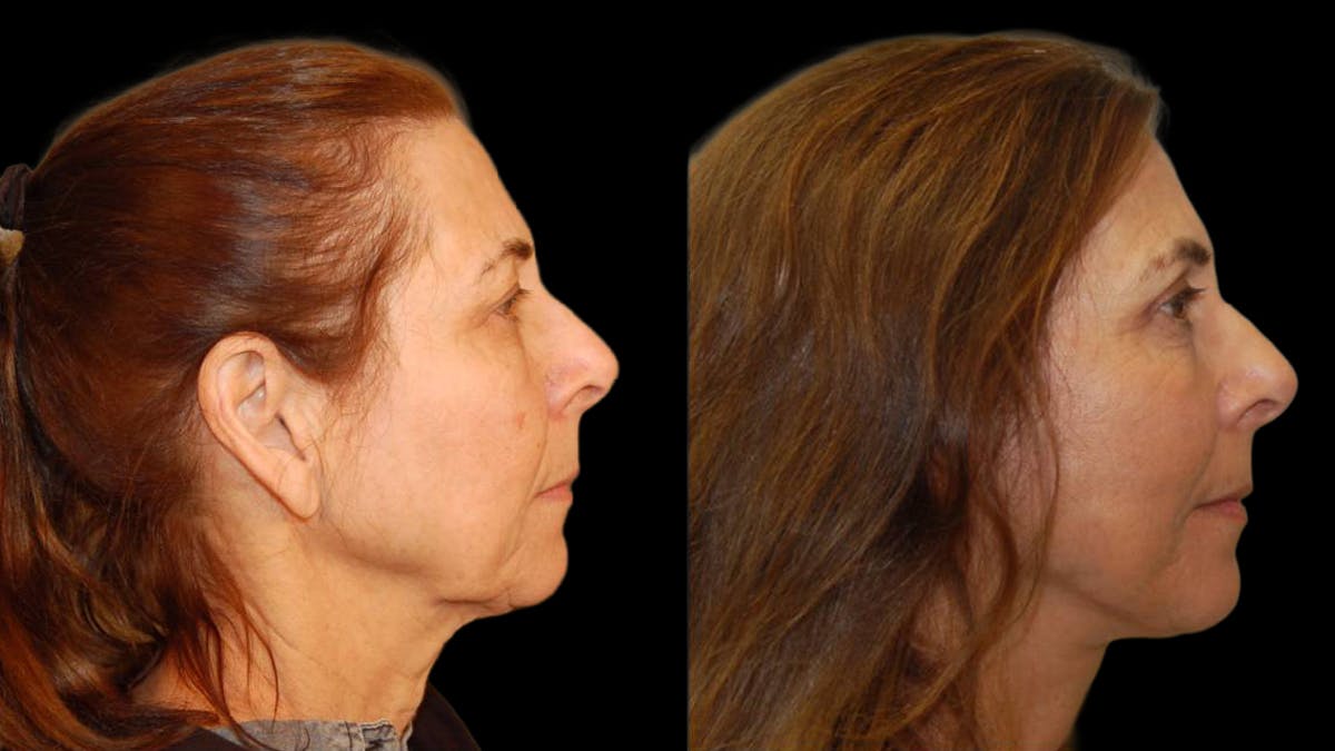 Mini Facelift Before & After Gallery - Patient 547755 - Image 5