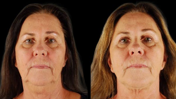 Mini Facelift Before & After Gallery - Patient 200819 - Image 1