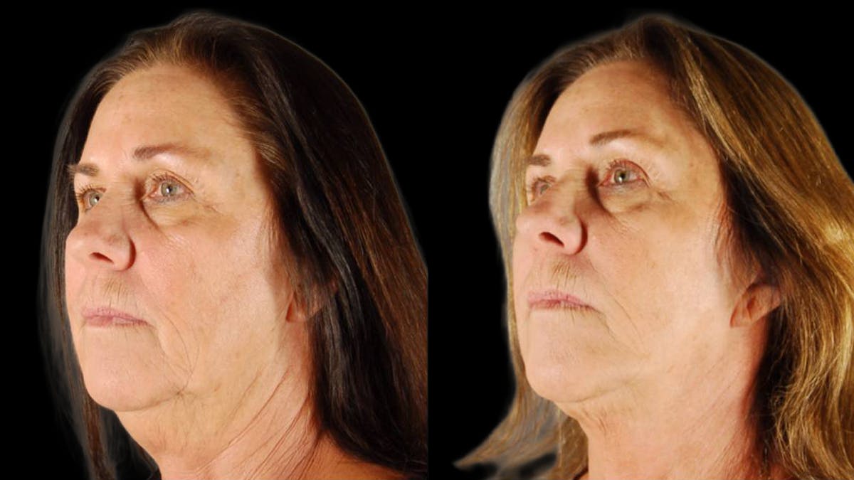 Mini Facelift Before & After Gallery - Patient 200819 - Image 2