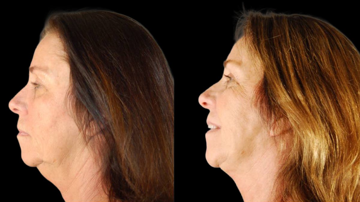 Mini Facelift Before & After Gallery - Patient 200819 - Image 3