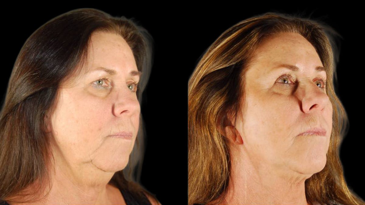 Mini Facelift Before & After Gallery - Patient 200819 - Image 4