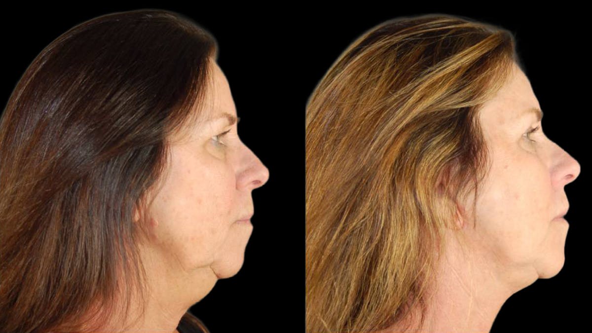 Mini Facelift Before & After Gallery - Patient 200819 - Image 5