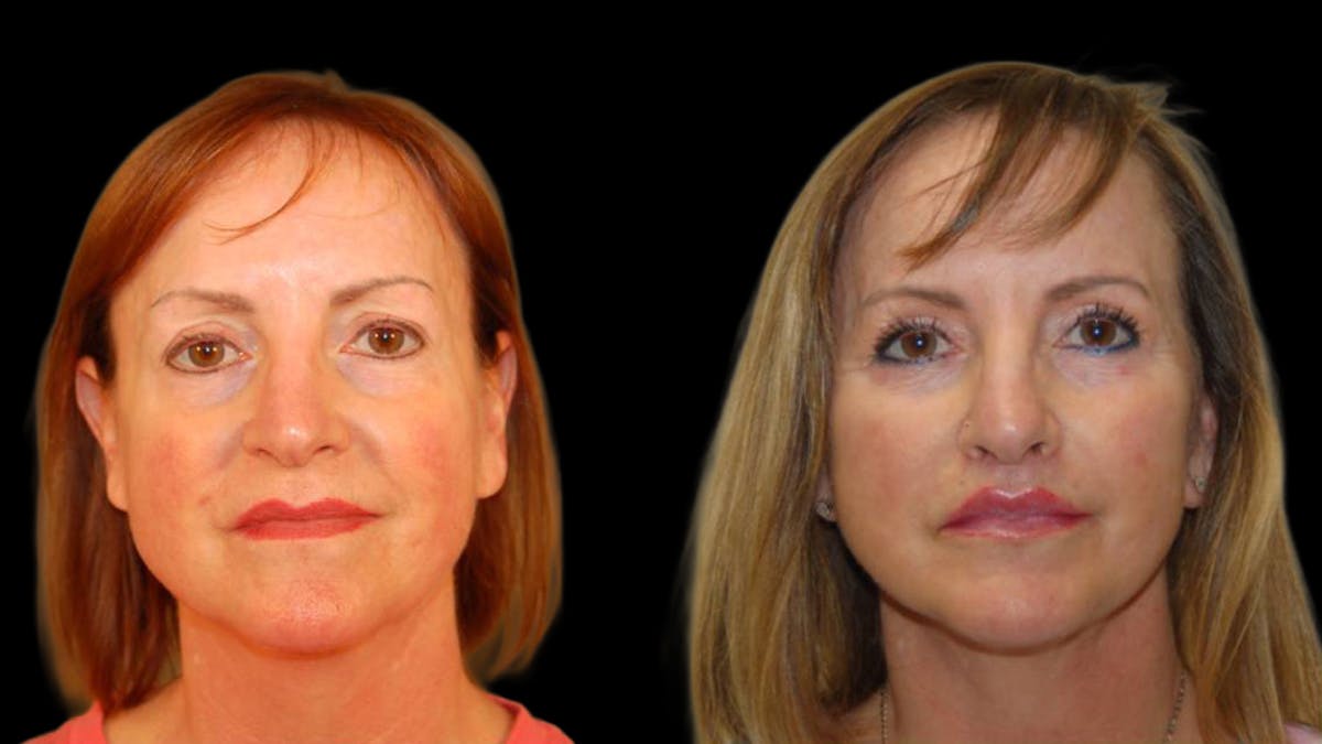 Mini Facelift Before & After Gallery - Patient 325479 - Image 1