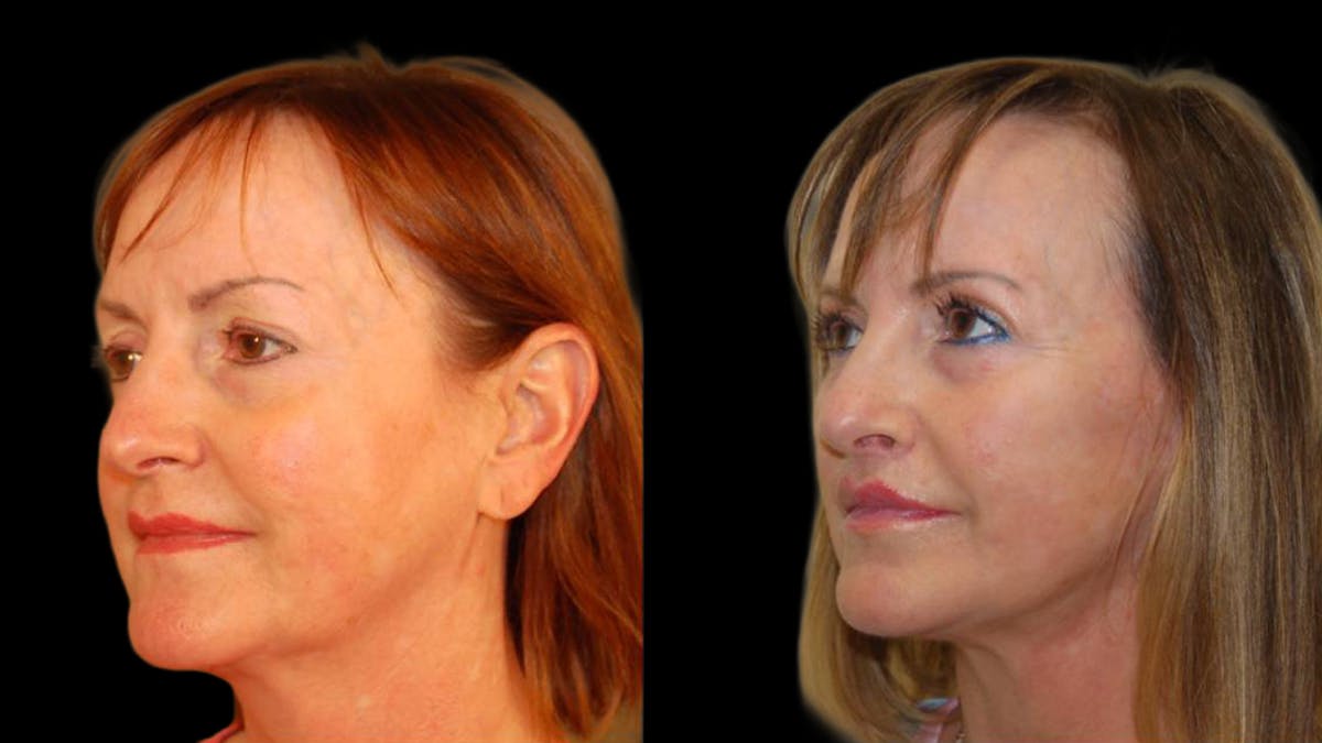 Mini Facelift Before & After Gallery - Patient 325479 - Image 2