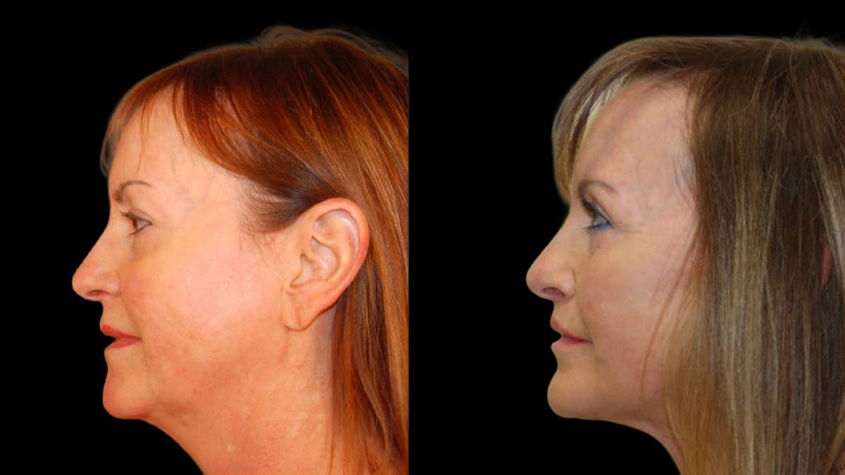 Mini Facelift Before & After Gallery - Patient 325479 - Image 3