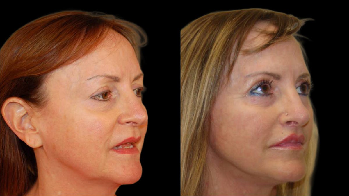 Mini Facelift Before & After Gallery - Patient 325479 - Image 4