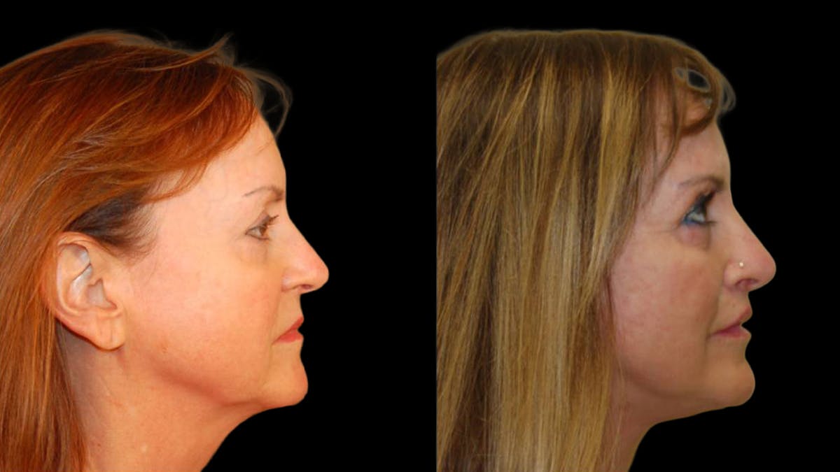 Mini Facelift Before & After Gallery - Patient 325479 - Image 5