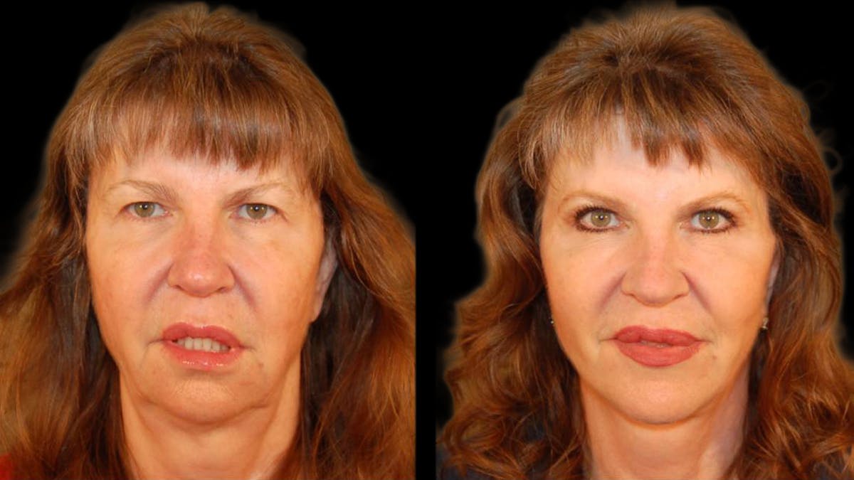 Mini Facelift Before & After Gallery - Patient 330427 - Image 1