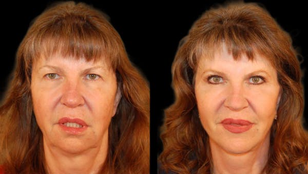 Mini Facelift Before & After Gallery - Patient 330427 - Image 1