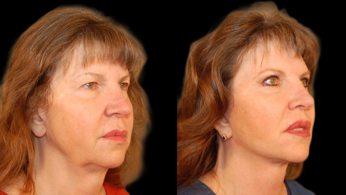Mini Facelift Before & After Gallery - Patient 330427 - Image 2