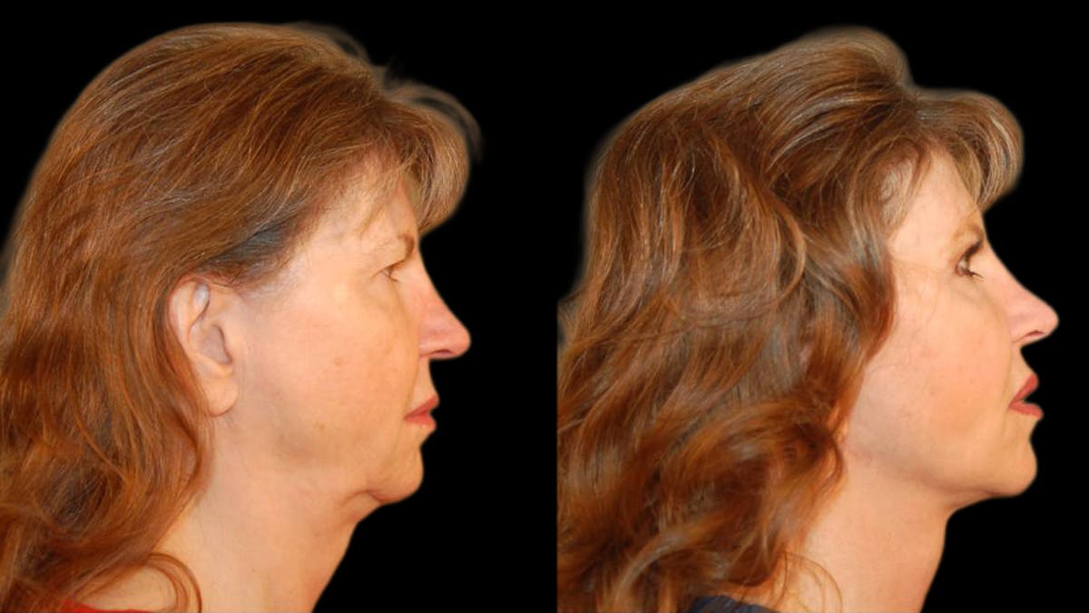 Mini Facelift Before & After Gallery - Patient 330427 - Image 3