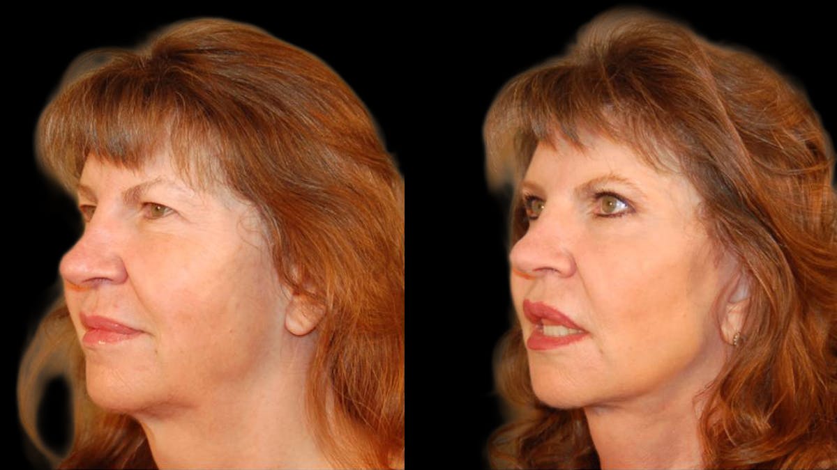 Mini Facelift Before & After Gallery - Patient 330427 - Image 4