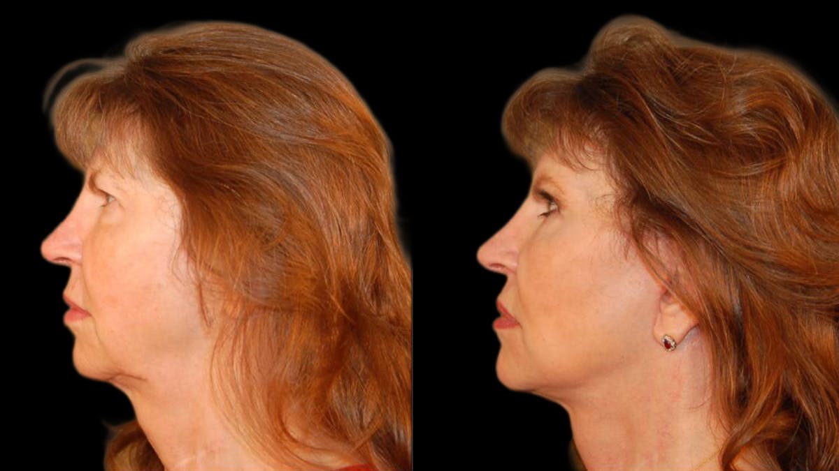 Mini Facelift Before & After Gallery - Patient 330427 - Image 5