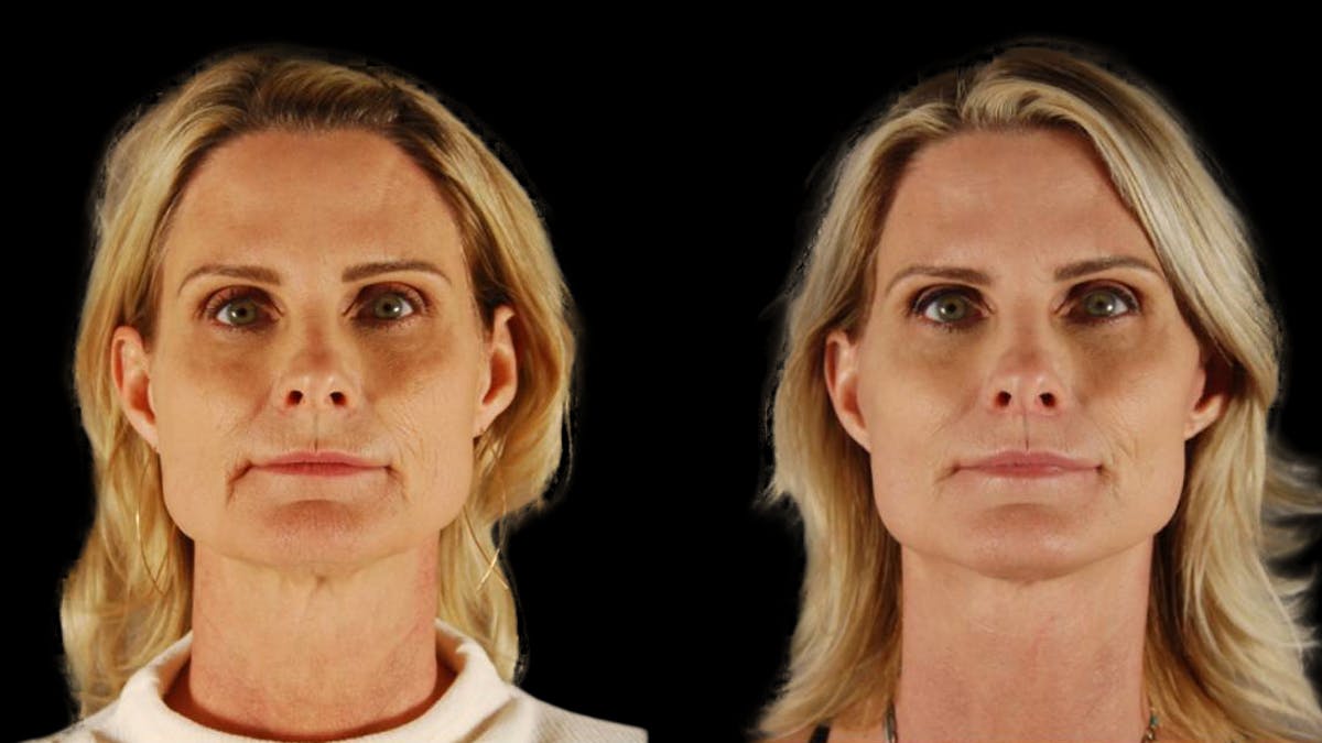 Mini Facelift Before & After Gallery - Patient 166595 - Image 1