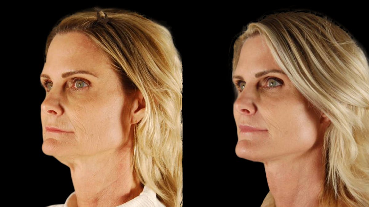 Mini Facelift Before & After Gallery - Patient 166595 - Image 2