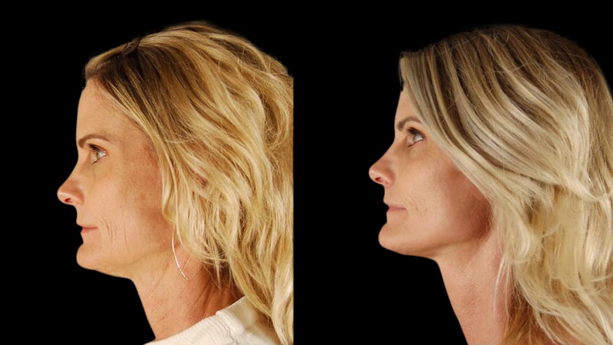 Mini Facelift Before & After Gallery - Patient 166595 - Image 3