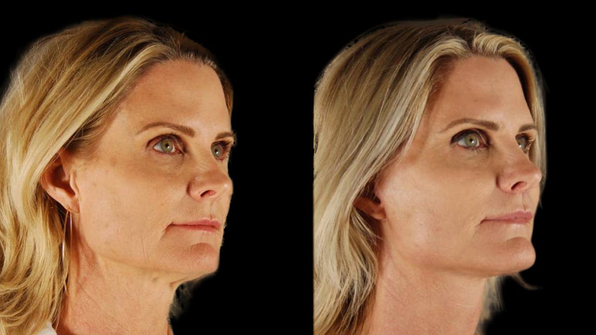 Mini Facelift Before & After Gallery - Patient 166595 - Image 4
