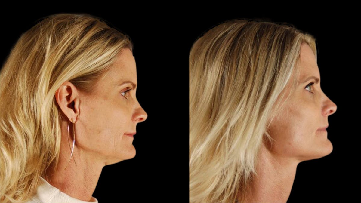 Mini Facelift Before & After Gallery - Patient 166595 - Image 5