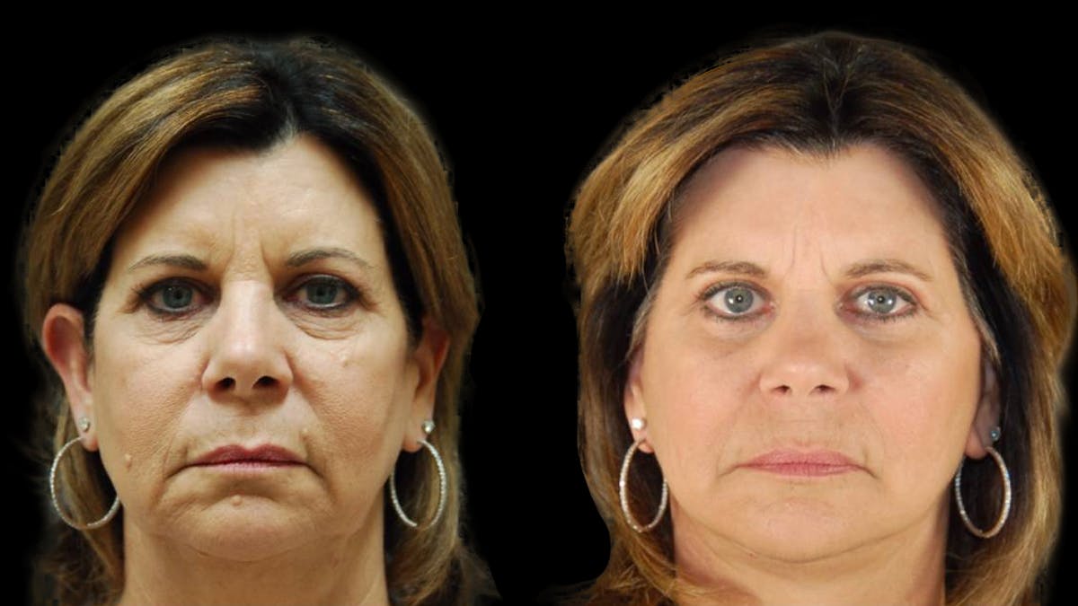 Mini Facelift Before & After Gallery - Patient 123021 - Image 1