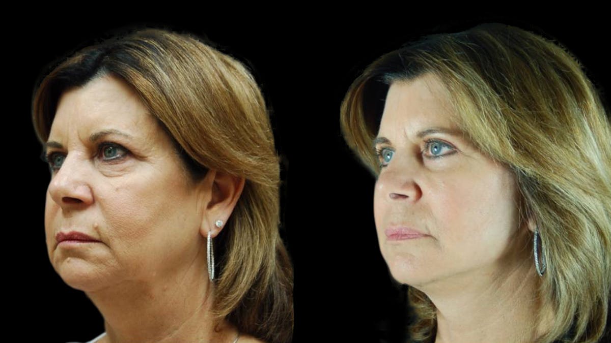 Mini Facelift Before & After Gallery - Patient 123021 - Image 2