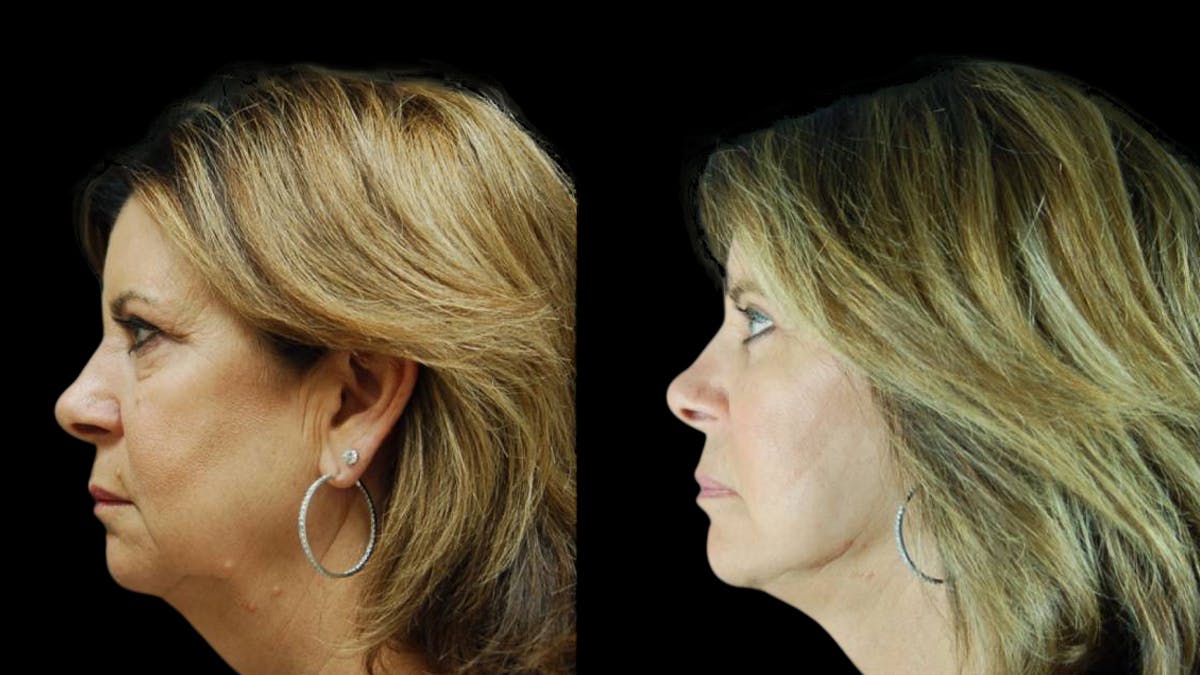 Mini Facelift Before & After Gallery - Patient 123021 - Image 3