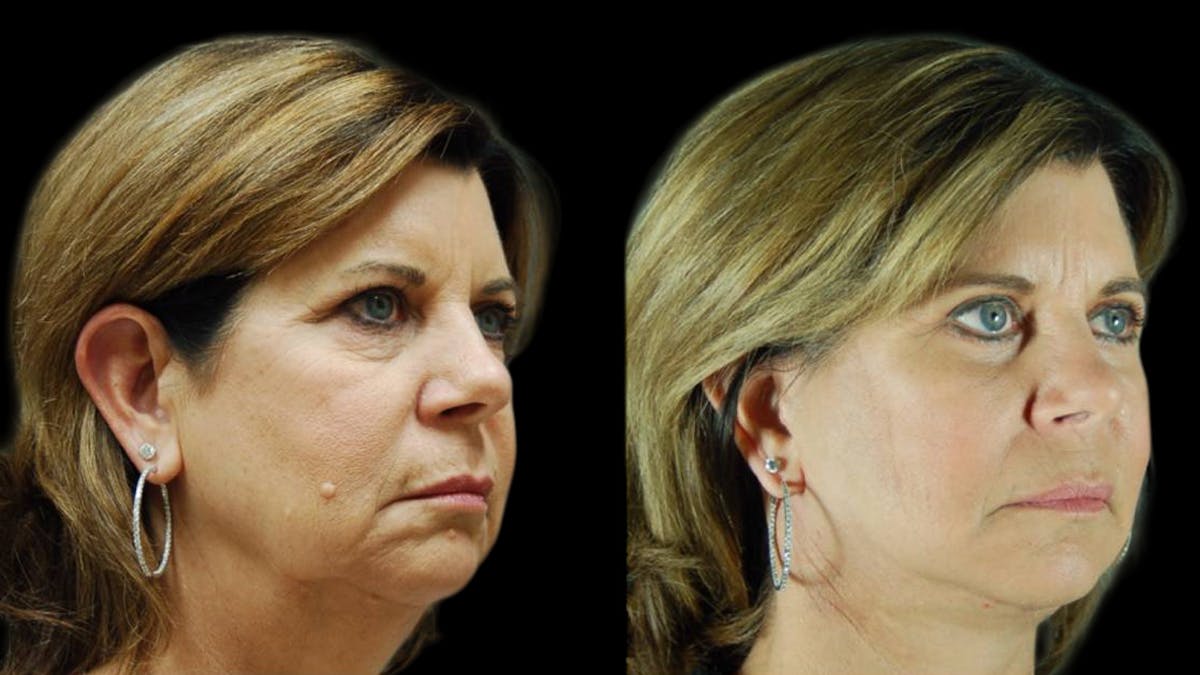 Mini Facelift Before & After Gallery - Patient 123021 - Image 4