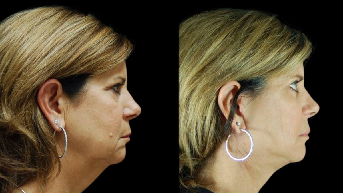 Mini Facelift Before & After Gallery - Patient 123021 - Image 5