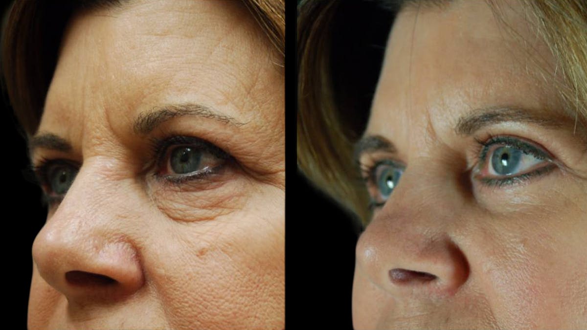 Mini Facelift Before & After Gallery - Patient 123021 - Image 6