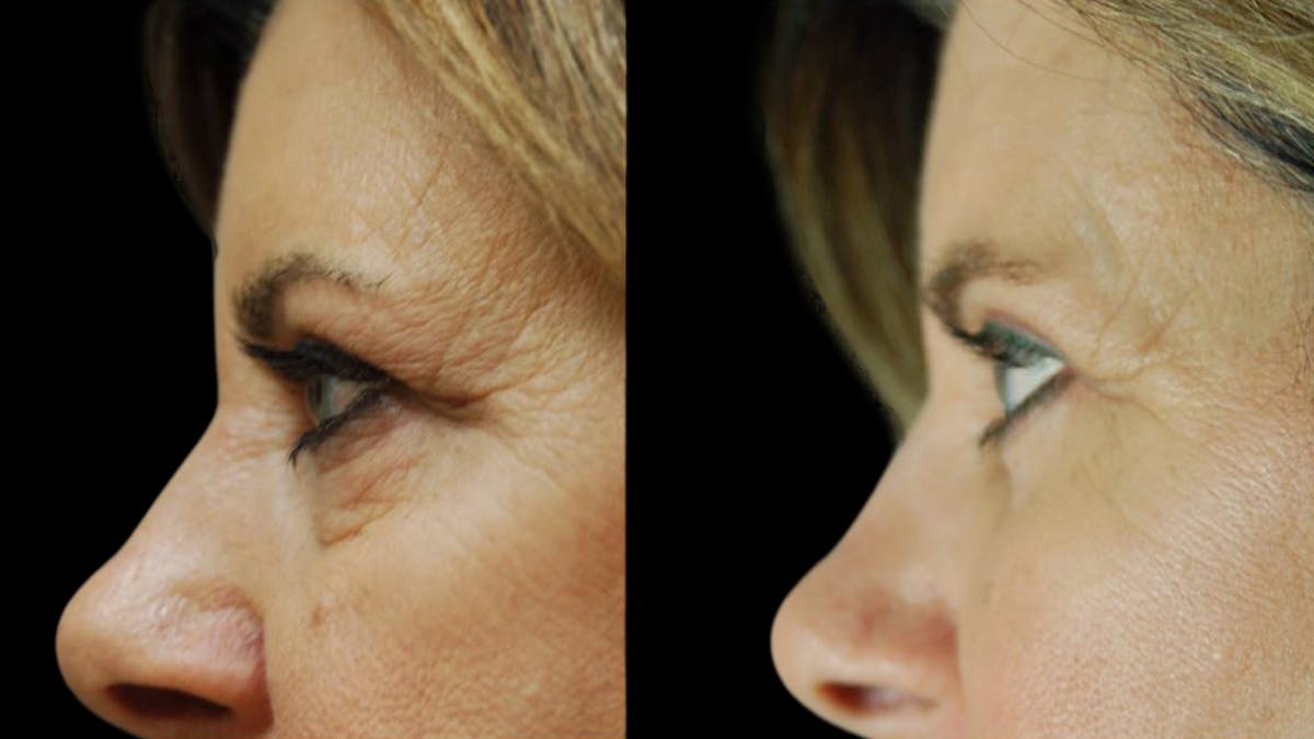 Mini Facelift Before & After Gallery - Patient 123021 - Image 7