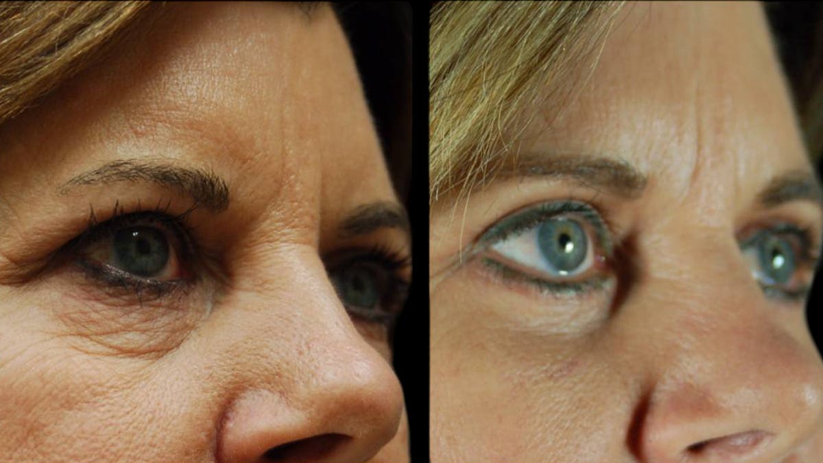 Mini Facelift Before & After Gallery - Patient 123021 - Image 8