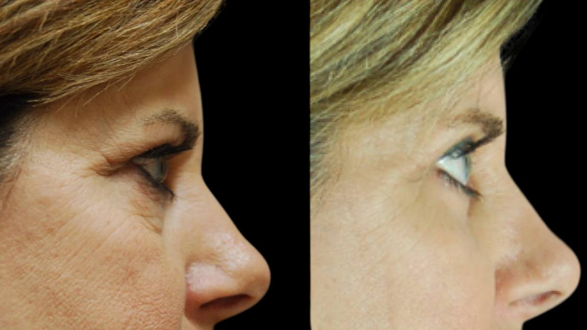 Mini Facelift Before & After Gallery - Patient 123021 - Image 9