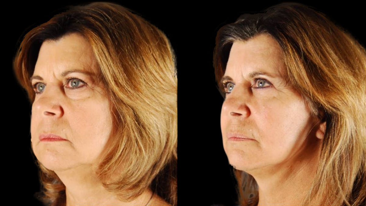 Mini Facelift Before & After Gallery - Patient 123021 - Image 10