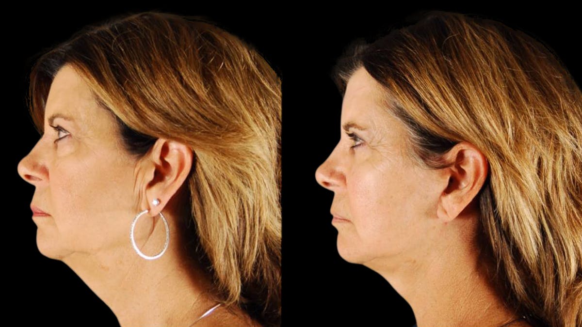 Mini Facelift Before & After Gallery - Patient 123021 - Image 11