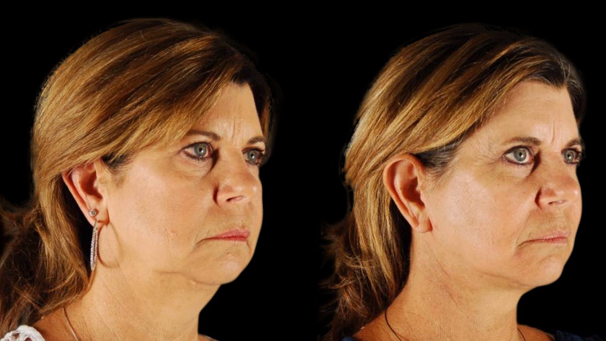Mini Facelift Before & After Gallery - Patient 123021 - Image 12