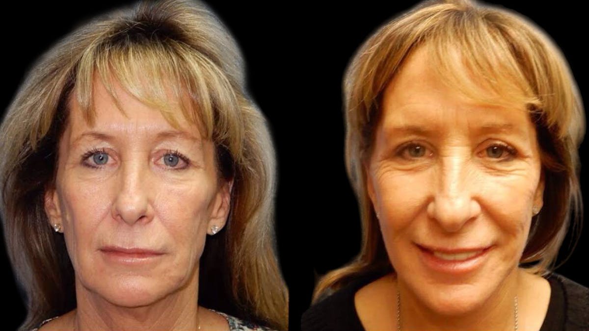 Mini Facelift Before & After Gallery - Patient 292515 - Image 1