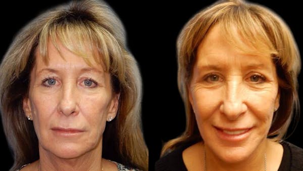 Mini Facelift Before & After Gallery - Patient 292515 - Image 1