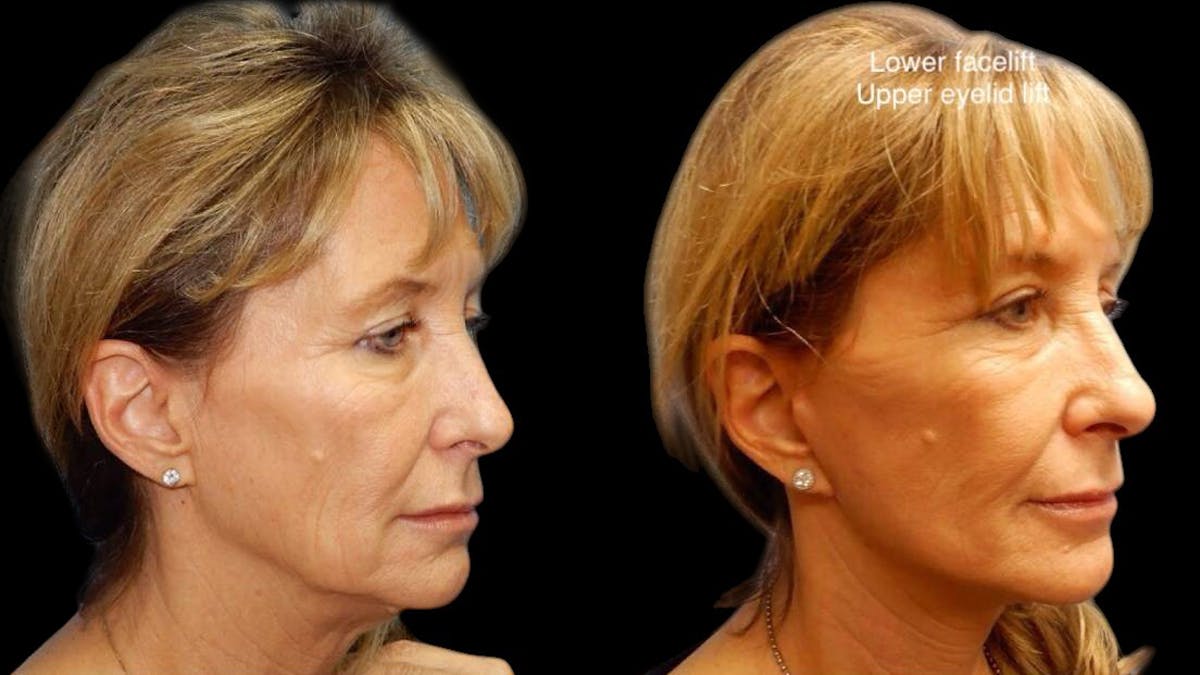 Mini Facelift Before & After Gallery - Patient 292515 - Image 2