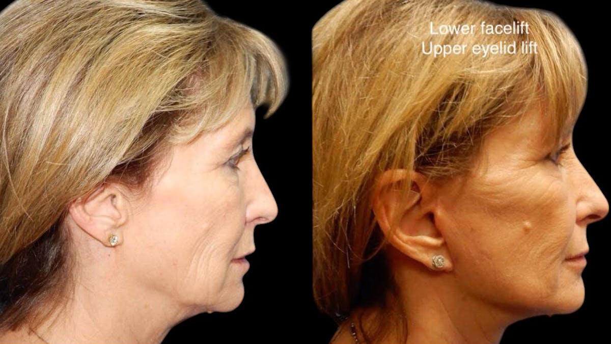 Mini Facelift Before & After Gallery - Patient 292515 - Image 3