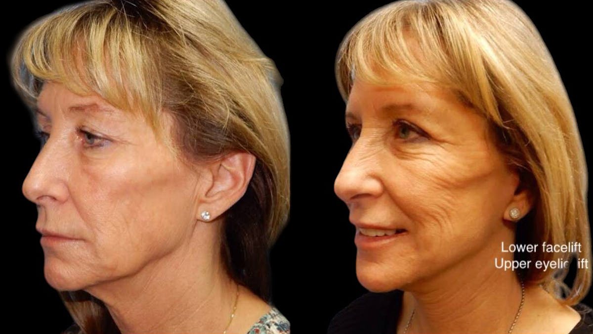 Mini Facelift Before & After Gallery - Patient 292515 - Image 4