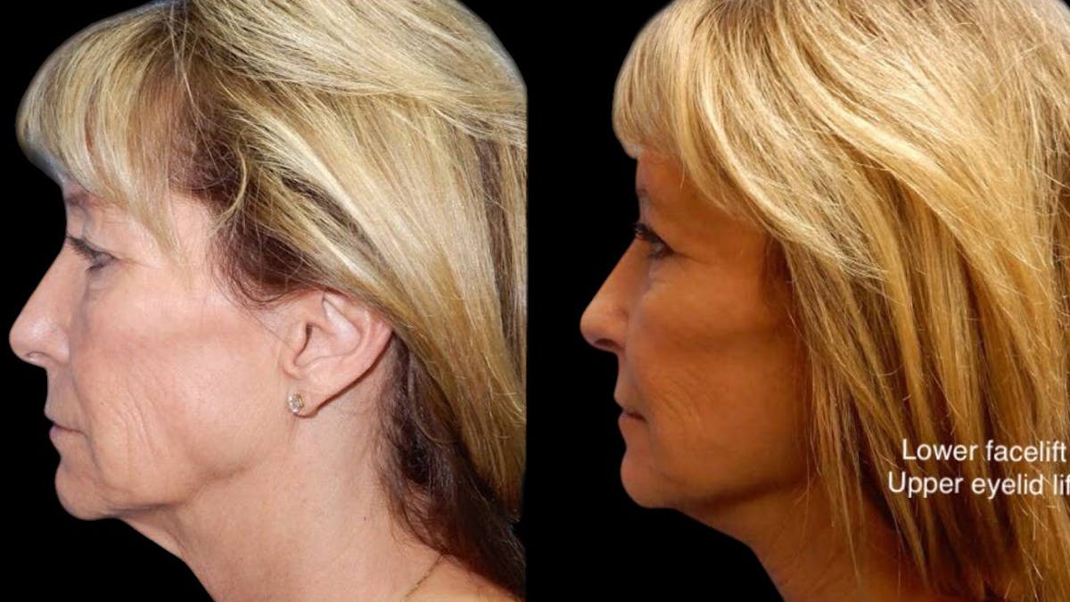 Mini Facelift Before & After Gallery - Patient 292515 - Image 5