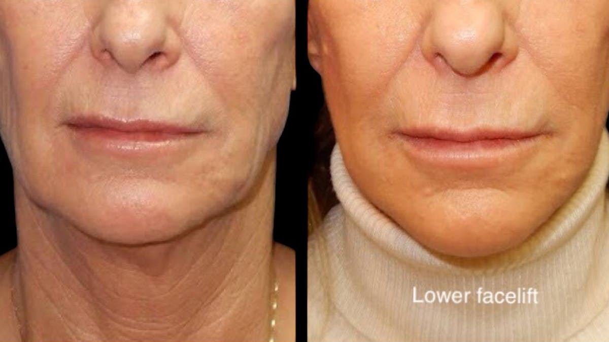 Mini Facelift Before & After Gallery - Patient 292515 - Image 6