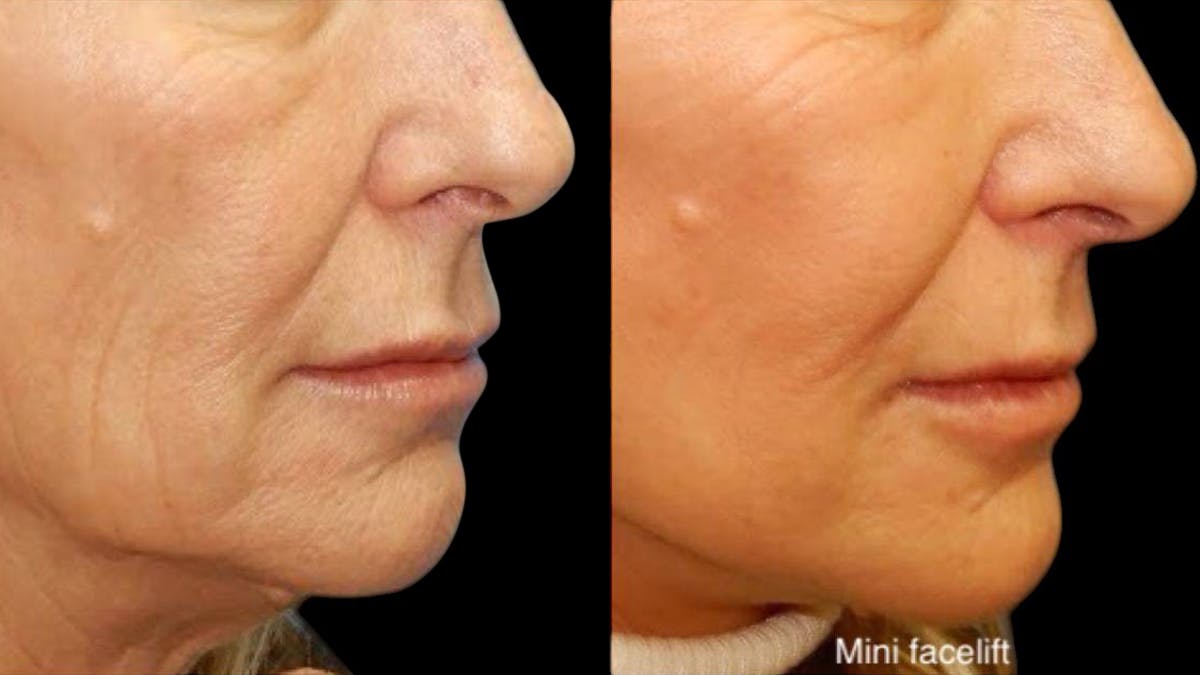 Mini Facelift Before & After Gallery - Patient 292515 - Image 7