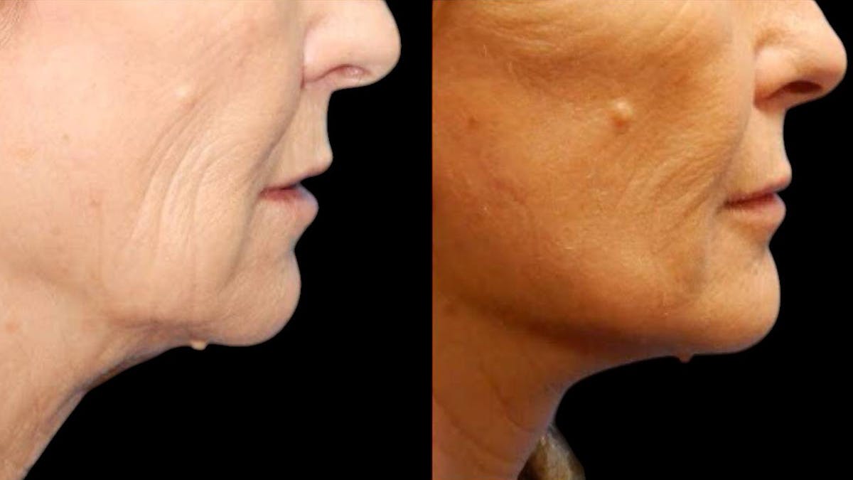 Mini Facelift Before & After Gallery - Patient 292515 - Image 8