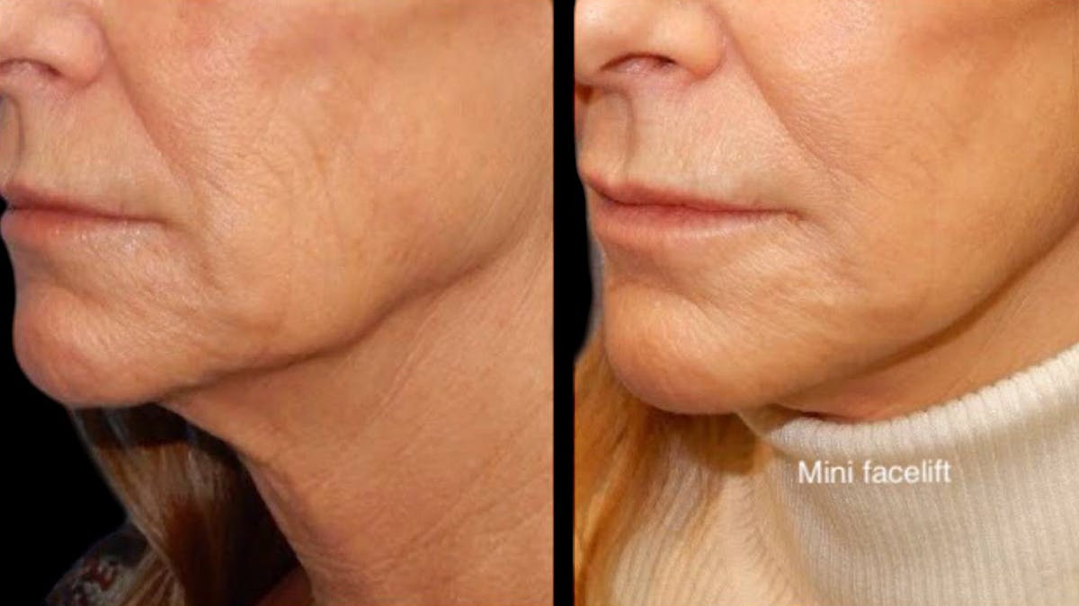 Mini Facelift Before & After Gallery - Patient 292515 - Image 9
