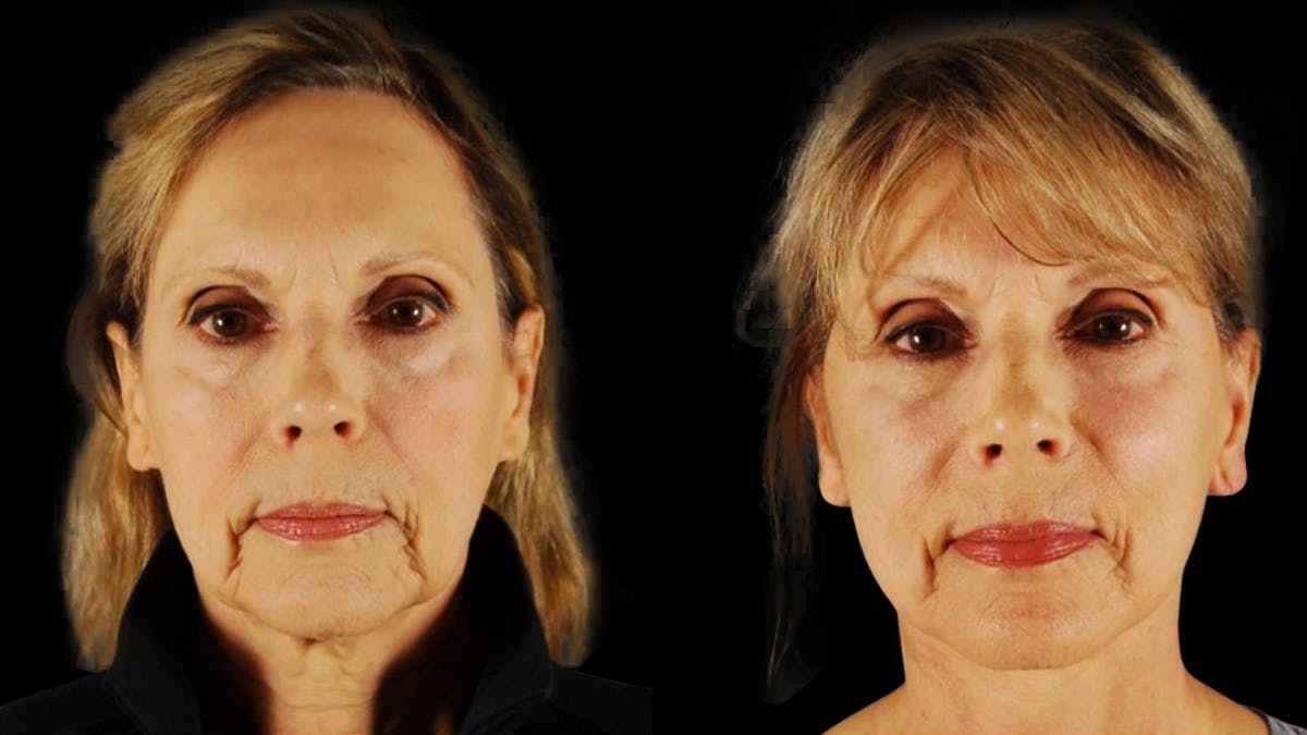 Mini Facelift Before & After Gallery - Patient 132903 - Image 1