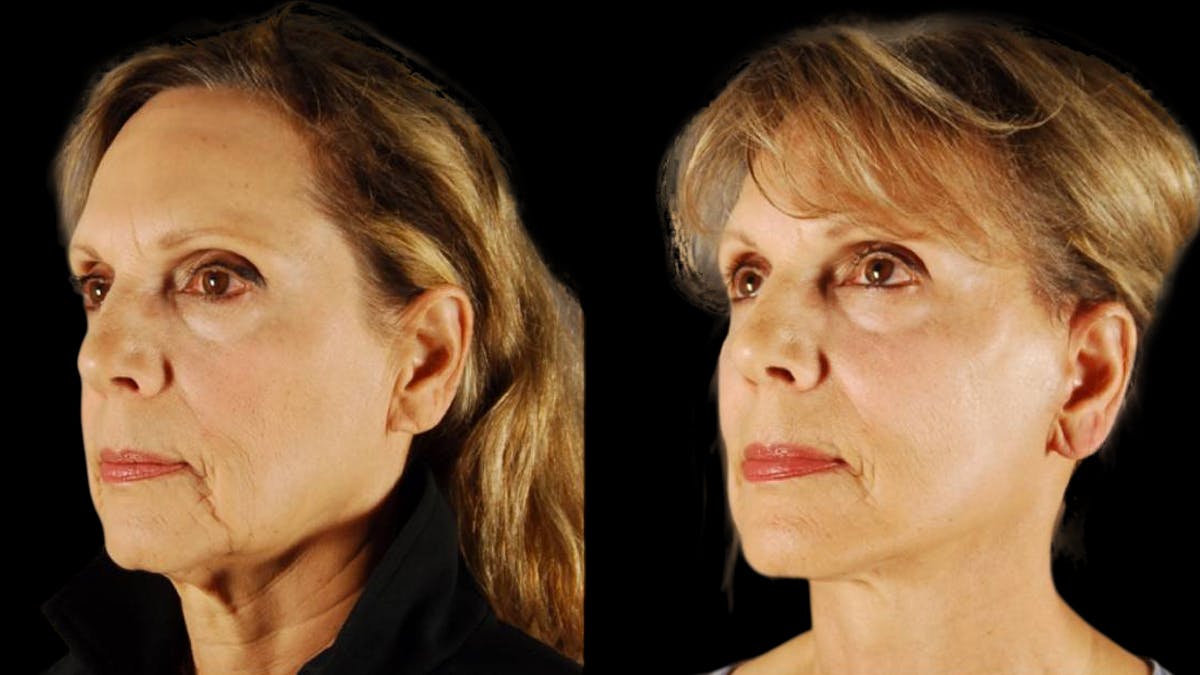 Mini Facelift Before & After Gallery - Patient 132903 - Image 2
