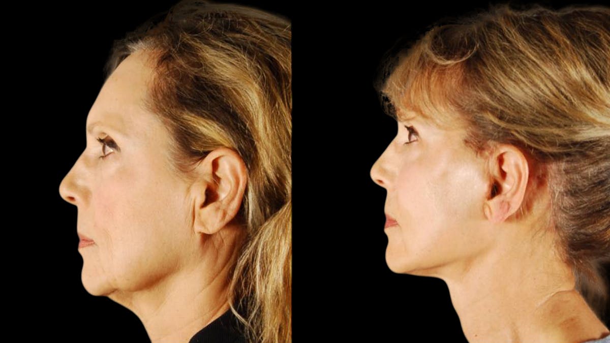 Mini Facelift Before & After Gallery - Patient 132903 - Image 3